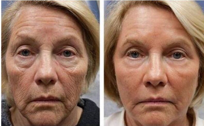 Φωτογραφίες πριν και μετά την εφαρμογή κρέμας Intenskin, δοκιμάστε το προϊόν